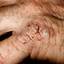 162. Eczema Hands Pictures