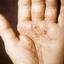 176. Eczema Hands Pictures