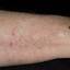18. Eczema Hands Pictures