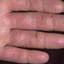 181. Eczema Hands Pictures