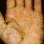 195. Eczema Hands Pictures