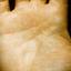 197. Eczema Hands Pictures