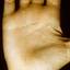 199. Eczema Hands Pictures