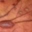 2. Eczema Hands Pictures