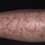 20. Eczema Hands Pictures