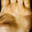 204. Eczema Hands Pictures