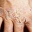 207. Eczema Hands Pictures