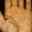 209. Eczema Hands Pictures