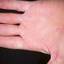 215. Eczema Hands Pictures