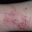 22. Eczema Hands Pictures