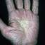 224. Eczema Hands Pictures