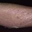 23. Eczema Hands Pictures