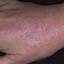 245. Eczema Hands Pictures