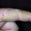25. Eczema Hands Pictures