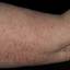 26. Eczema Hands Pictures