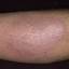 27. Eczema Hands Pictures