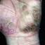 281. Eczema Hands Pictures