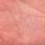 286. Eczema Hands Pictures