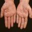 288. Eczema Hands Pictures