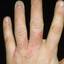 296. Eczema Hands Pictures