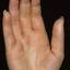 297. Eczema Hands Pictures
