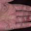 299. Eczema Hands Pictures
