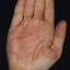 300. Eczema Hands Pictures