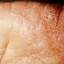 302. Eczema Hands Pictures