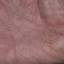 309. Eczema Hands Pictures