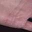 316. Eczema Hands Pictures