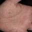 324. Eczema Hands Pictures