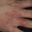 328. Eczema Hands Pictures