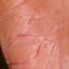 34. Eczema Hands Pictures