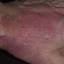 340. Eczema Hands Pictures