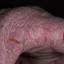 342. Eczema Hands Pictures
