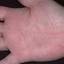 349. Eczema Hands Pictures