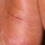 35. Eczema Hands Pictures