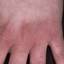 350. Eczema Hands Pictures
