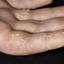 358. Eczema Hands Pictures