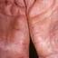36. Eczema Hands Pictures