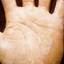 365. Eczema Hands Pictures