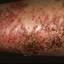 367. Eczema Hands Pictures