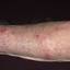 368. Eczema Hands Pictures