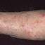 369. Eczema Hands Pictures