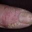 37. Eczema Hands Pictures