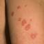 378. Eczema Hands Pictures