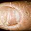 38. Eczema Hands Pictures