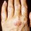391. Eczema Hands Pictures