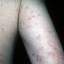 392. Eczema Hands Pictures