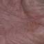 4. Eczema Hands Pictures